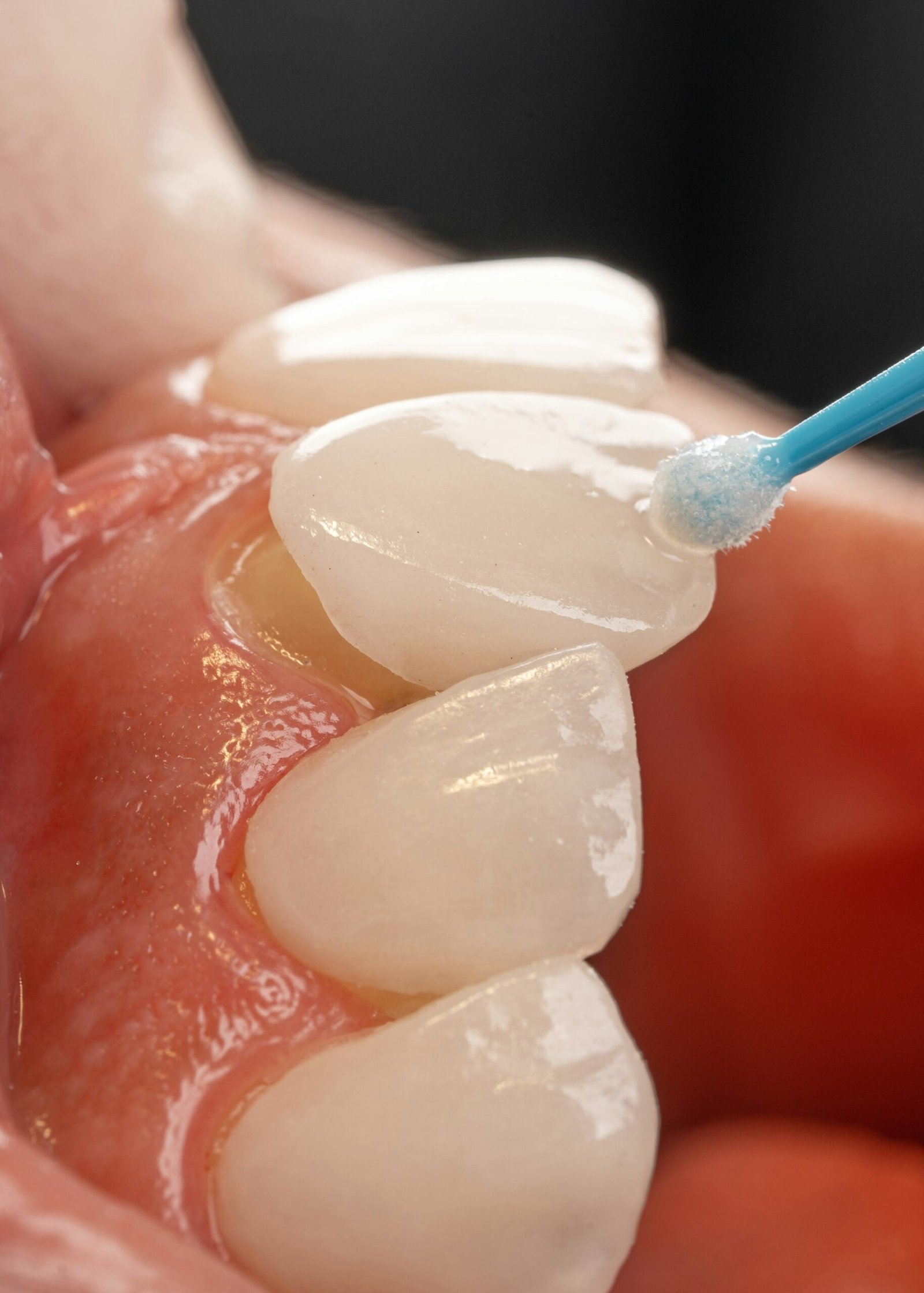 a tooth with a blue toothbrush in it